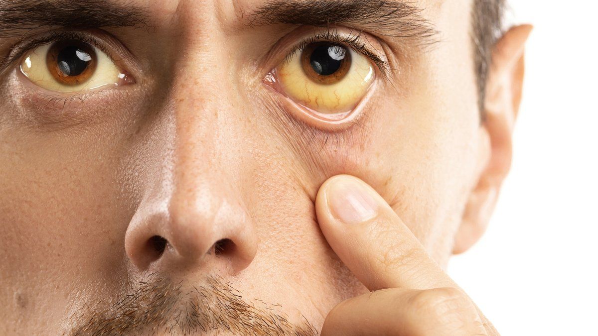 Le syndrome de Gilbert : ce qui a conduit Pierre Ouzoulias à vomir en pleine séance