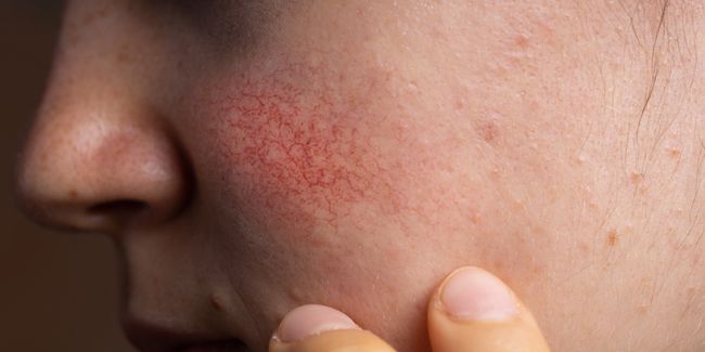 La couperose : entre causes et solutions