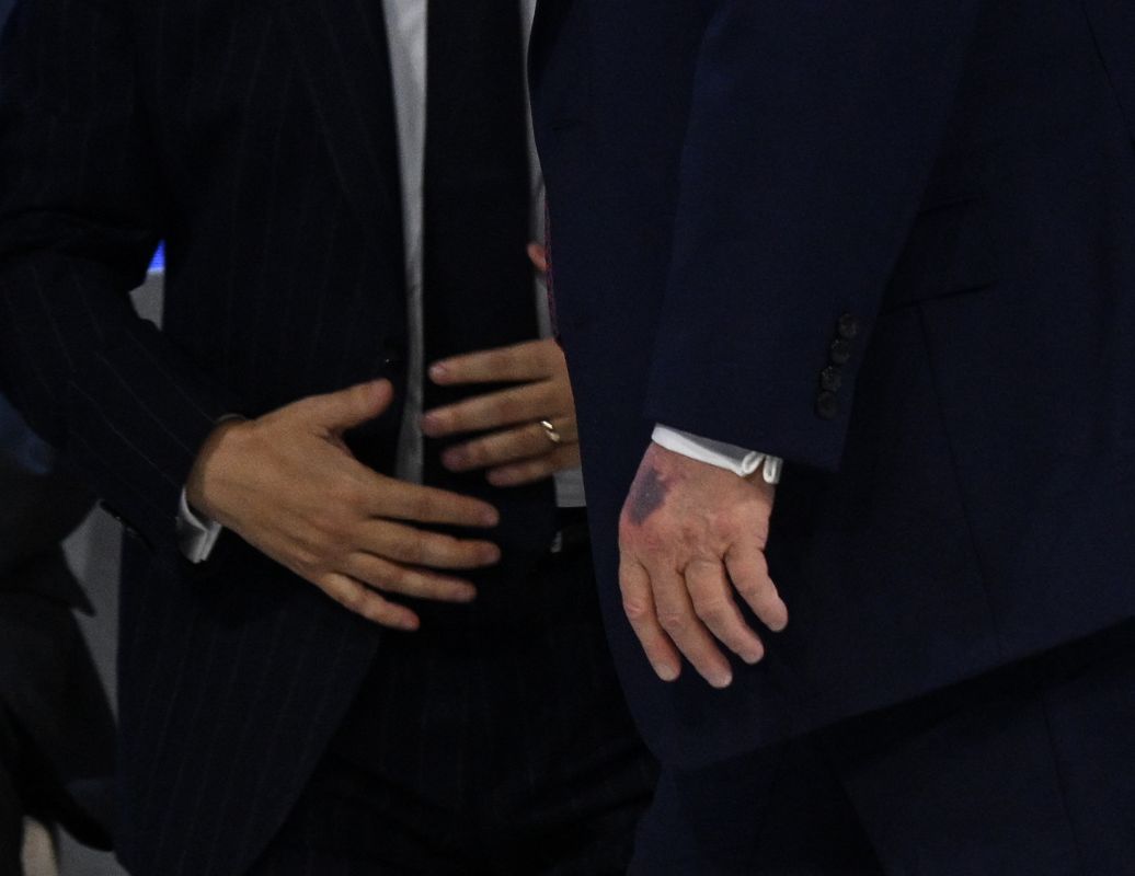 Trump explique ses ecchymoses : un choc ou l’aspirine en cause ?