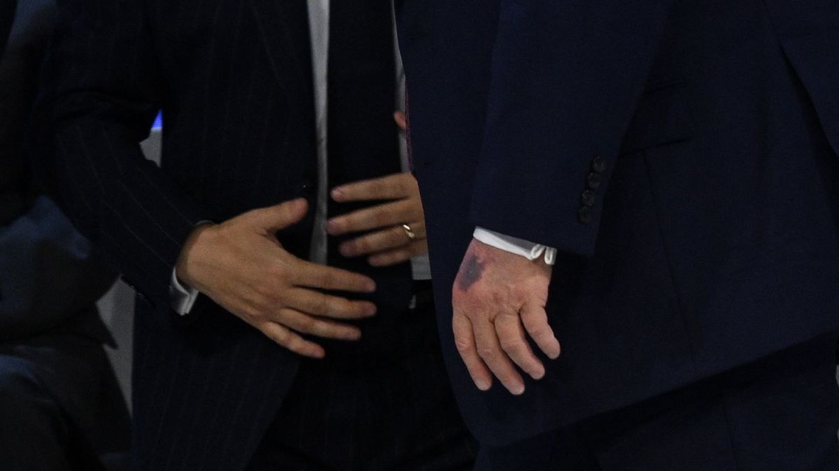 Une ecchymose sur la main de Trump : un accident ou un signe inquiétant ?